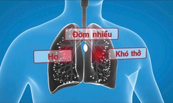 Ho, đờm k&#233;o d&#224;i do vi&#234;m phế quản phải l&#224;m sao?