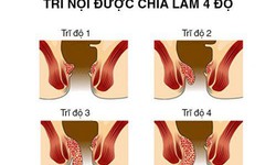 Dấu hiệu v&#224; c&#225;ch đẩy l&#249;i trĩ nội độ 1