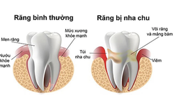 Bệnh vi&#234;m nha nhu v&#224; c&#225;ch điều trị