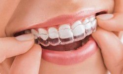 Niềng răng trong suốt invisalign n&#234;n hay kh&#244;ng n&#234;n?