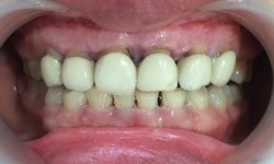 Hậu quả nghi&#234;m trọng khi bọc răng sứ k&#233;m chất lượng?