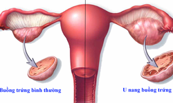 Bệnh u nang buồng trứng v&#224; giải ph&#225;p cải thiện hiệu quả từ thảo dược