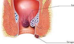 Chuy&#234;n gia &quot;m&#225;ch&quot; bạn c&#225;ch điều trị trĩ cấp đ&#250;ng, hiệu quả nhanh