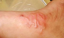 Bệnh nh&#226;n ho khạc ra sinh vật nhỏ, nhiễm tr&#249;ng li&#234;n tục v&#236; “d&#237;nh” giun lươn