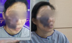 &quot;Ho&#225; giải&quot; khối u m&#225;u khủng &quot;ăn&quot; gần nửa khu&#244;n mặt nữ c&#244;ng nh&#226;n ngh&#232;o