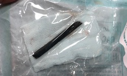Đoạn đũa dài 7 cm nằm 4 năm trong hốc mắt người đàn ông
