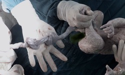 Cứu sống b&#233; sơ sinh bị thắt 2 n&#250;t d&#226;y rốn