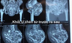 11 giờ phẫu thuật, truyền 22 l&#237;t m&#225;u, cứu sống c&#244; g&#225;i mang khối u khổng lồ