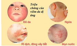 Thuốc sinh học trị vi&#234;m da dị ứng ở trẻ em từ trung b&#236;nh đến nặng