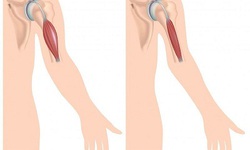 Thuốc mới trị bệnh loạn dưỡng cơ Duchenne do đột biến gen