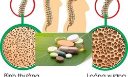 Cảnh b&#225;o nguy cơ l&#224;m yếu xương của thuốc corticosteroid trị hen suyễn