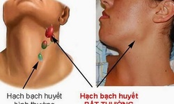 Thuốc mới trị ung thư hạch t&#225;i ph&#225;t, kh&#225;ng trị: Một số cẩn trọng khi d&#249;ng