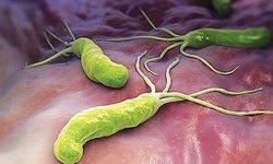 Nhiễm vi khuẩn Helicobacter Pylori (HP) c&#243; trở th&#224;nh ung thư?