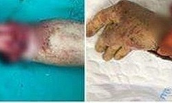 Người phụ nữ bị máy tuốt lúa chém đứt rời cẳng tay được nối thành công