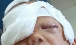 Chơi 1 mình trong bếp, bé 20 tháng tuổi bị chó nhà cắn xé rách vùng đầu mặt