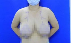 &quot;Giải ph&#243;ng&quot; bộ ngực khủng gần 3kg cho nữ bệnh nh&#226;n 38 tuổi