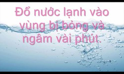 Top 10 mẹo trị bỏng