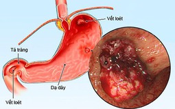 C&#225;c thuốc điều trị lo&#233;t dạ d&#224;y t&#225; tr&#224;ng