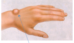 Những yếu tố nguy cơ nào dẫn đến nang bao hoạt dịch cổ tay?