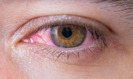 Ph&#242;ng v&#224; điều trị đau mắt đỏ sau mưa lũ