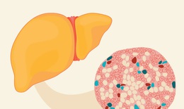 Gan nhiễm mỡ: Nhận biết dấu hiệu, nguyên nhân và điều trị sớm để ngừa xơ gan