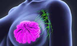 Ung thư vú  - Nguyên nhân, dấu hiệu nhận biết và cách tầm soát