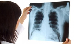 Các phương pháp điều trị ung thư phổi hiện nay ra sao?