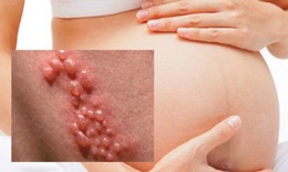 Ảnh hưởng của nhiễm virus herpes đến thai kỳ như thế nào?