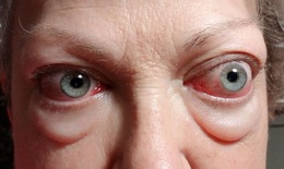 Khi bệnh nhân tuyến giáp phải đến khám bác sĩ mắt