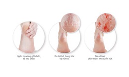 Ứng phó với chứng da khô nứt nẻ, da vảy cá trong mùa đông