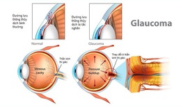 Glaucoma - 'Kẻ đánh cắp' thị giác thầm lặng