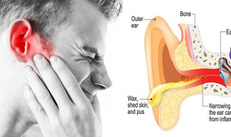 Mắc bệnh ở tai có thể gây liệt mặt và những điều cần lưu ý