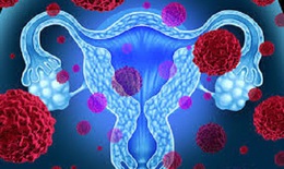 Ung thư buồng trứng: Dấu hiệu, nguyên nhân và phương pháp điều trị