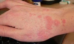 Một số thuốc có thể dùng trị viêm da tiếp xúc