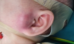 Nhọt ống tai ở trẻ nhỏ