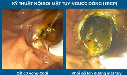 Chạy đua với thời gian cứu sống người bệnh bị sốc nhiễm tr&#249;ng đường mật