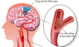 3 dấu hiệu sớm cảnh báo đột quỵ trước cả FAST