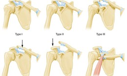 Không nên chủ quan khi bị sai khớp cùng đòn