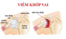 Các phương pháp hỗ trợ điều trị viêm quanh khớp vai