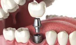 5 điều cần l&#224;m sau khi thực hiện cấy gh&#233;p răng Implant