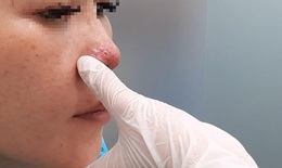 Tiêm filler nâng mũi ở spa, một phụ nữ ở TP.HCM bị biến chứng hoại tử