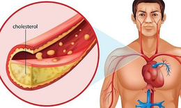 Cholesterol cao đẩy nhanh tốc độ xơ vữa mạch vành, thiếu máu cơ tim