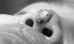 Nhiễm khuẩn, thủng đầu mũi sau nâng mũi 4 năm