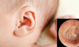 Ph&#242;ng ngừa v&#224; nhận biết những biến chứng nguy hiểm do vi&#234;m tai giữa tiết dịch ở trẻ