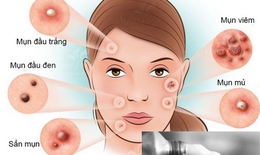 Thêm một lựa chọn điều trị cho người bị mụn trứng cá