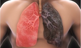 Ung thư phổi không đáng sợ nếu biết rõ nguyên nhân và cách phòng ngừa