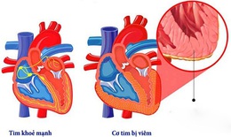 Cảnh giác với bệnh viêm cơ tim ở trẻ