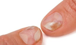 Nấm móng tay có thuốc nào để trị?