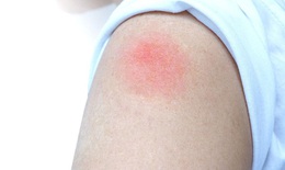 Phản ứng “cánh tay COVID-19” sau tiêm vaccine có đáng ngại?