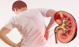 Phòng bệnh sỏi thận ở nam giới tuổi trung niên